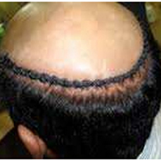Hair-Weaving-camouflaging-tricks-face-value-hair-transplant-clinic-in mumbai-india